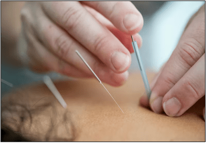 acupuncture needles