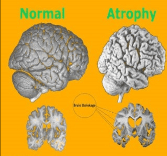 normal vs atrophy brain